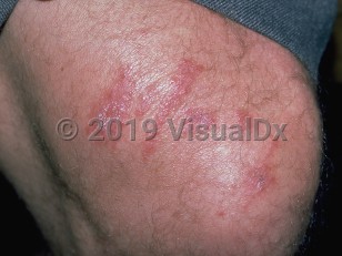 Clinical image of Coral injury - imageId=295689. Click to open in gallery.  caption: 'Linear and patterned edematous and erythematous papules and plaques on the knee from coral.'