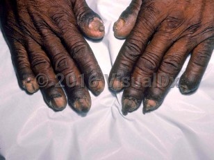 Clinical image of Pachydermoperiostosis syndrome - imageId=2968511. Click to open in gallery.  caption: 'Bulbous swelling of the distal phalanx of the fingers that stops abruptly at the distal interphalangeal joint. Note the associated onychodystrophy and increased transverse nail curvature.'
