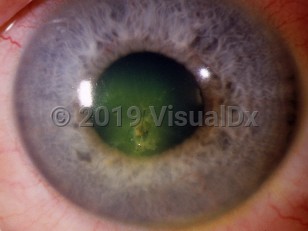 Clinical image of Corneal foreign body - imageId=2985849. Click to open in gallery. 