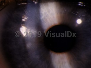 Clinical image of Lyme keratitis - imageId=2986751. Click to open in gallery. 