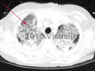 Imaging Studies image of Haemophilus influenzae pneumonia - imageId=2997660. Click to open in gallery.  caption: 'Image from CT scan of the chest in lung windows demonstrating bilateral, diffuse ground glass opacities in the setting of chronic lung disease. '