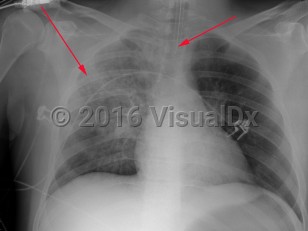Imaging Studies image of Staphylococcus aureus pneumonia - imageId=2997983. Click to open in gallery.  caption: 'AP supine chest x-ray demonstrating a diffuse right-sided opacity which may be related to layering of a pleural effusion. In addition, there are poorly defined nodular opacities on the right, (long arrow). Endotracheal tube is present, (short arrow).'