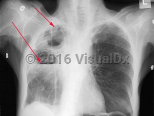 Imaging Studies image of Pseudomonas pneumonia - imageId=2998819. Click to open in gallery.  caption: 'Frontal chest x-ray demonstrating at least two cavities in the right upper lobe. One of the cavities has an air fluid level possibly representing an abscess, (long arrow). There is a right-sided central venous catheter.'