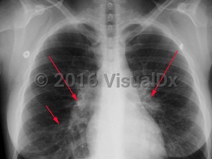 Imaging Studies image of Mycoplasma pneumonia - imageId=3003508. Click to open in gallery.  caption: 'Frontal chest x-ray demonstrating bilateral hilar lymphadenopathy, (long arrows), as well as fine reticular opacities in the bilateral lower lobes (right greater than left), (short arrow).'