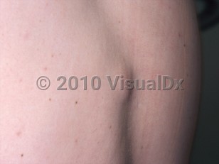 Clinical image of Lipoma - imageId=301128. Click to open in gallery.  caption: 'Skin-colored and slightly pink nodule on the back.'