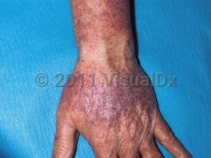 Clinical image of Lichenoid drug eruption - imageId=301644. Click to open in gallery.  caption: 'Scaly, violaceous papules and plaques on the arm and dorsal hand.'