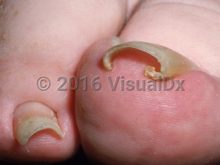 Clinical image of Pincer nail deformity - imageId=3018595. Click to open in gallery.  caption: 'Increased transverse curvature of the toenail, indenting the underlying skin.'