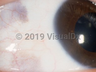 Clinical image of Conjunctival melanosis - imageId=3071118. Click to open in gallery. 