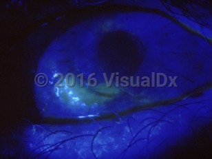 Clinical image of Trichiasis - imageId=3077120. Click to open in gallery.  caption: 'A corneal abrasion secondary to trichiasis.'
