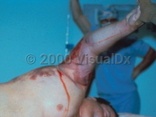 Clinical image of Gas gangrene - imageId=308081. Click to open in gallery.  caption: 'Extensive bluish discoloration of the arm (devitalized tissue) with secondary ulceration. Note also the retiform violaceous and maroon plaques on the lateral chest.'