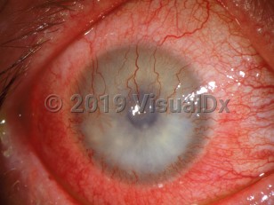 Clinical image of Corneal neovascularization - imageId=3089395. Click to open in gallery. 