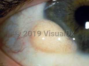 Clinical image of Epibulbar dermoid cyst - imageId=3103756. Click to open in gallery.  caption: 'A yellowish-white, firm, rounded, fleshy papule at the limbus.'