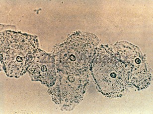 Lab image of Bacterial vaginosis - imageId=311617. Click to open in gallery. 