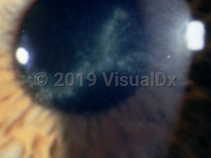 Clinical image of Acanthamoeba keratitis - imageId=3119580. Click to open in gallery. 