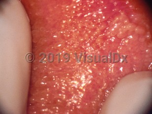 Clinical image of Vestibular papillomatosis - imageId=313500. Click to open in gallery. 