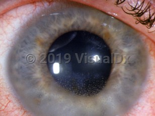 Clinical image of Uveitis - imageId=3140168. Click to open in gallery. 