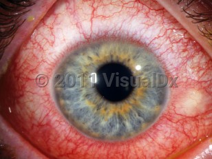 Clinical image of Toxic conjunctivitis - imageId=3140555. Click to open in gallery. 