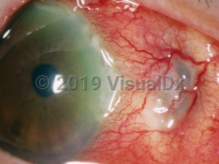 Clinical image of Necrotizing scleritis - imageId=3158975. Click to open in gallery. 