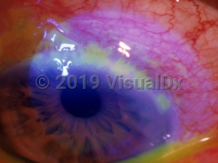 Clinical image of Herpes simplex virus conjunctivitis - imageId=3175118. Click to open in gallery. 