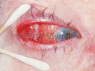 Clinical image of Lacrimal gland tumor - imageId=3180152. Click to open in gallery. 