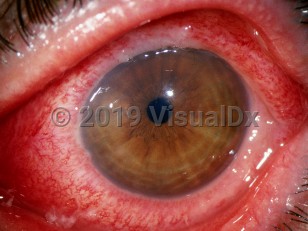 Clinical image of Bacterial conjunctivitis - imageId=3193157. Click to open in gallery. 