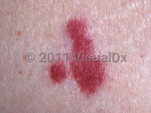 Clinical image of Vasculitis - imageId=323385. Click to open in gallery.  caption: 'A close-up of palpable purpura.'