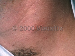 Clinical image of Branchial cleft cyst or sinus - imageId=324828. Click to open in gallery.  caption: 'A smooth, yellowish papule with surrounding erythema, on the lateral neck.'