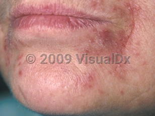 Clinical image of Perioral dermatitis - imageId=326179. Click to open in gallery.  caption: 'Multiple tiny erythematous papules coalescing to form a plaque, with minimal scale at the oral commissure. Note the sparing of the lip margin.'
