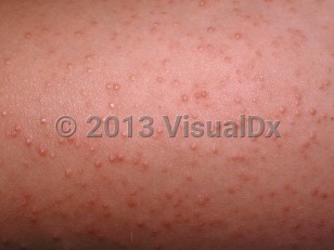 Clinical image of Keratosis pilaris - imageId=32898. Click to open in gallery.  caption: 'A close-up of follicularly-based, scaly, erythematous papules.'