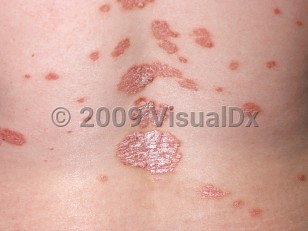 Clinical image of Psoriasis - imageId=329024. Click to open in gallery.  caption: 'Well-demarcated annular scaly papules and plaques with erythema on the back.'