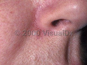 Clinical image of Common acquired nevus - imageId=329792. Click to open in gallery.  caption: 'A skin-colored papule (intradermal nevus) at the nasal alar crease.'