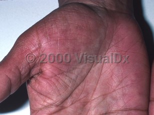 Clinical image of Hepatitis C virus infection - imageId=330635. Click to open in gallery.  caption: 'Deep red palmar erythema in an HIV-infected patient.'