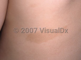 Clinical image of Café au lait spot - imageId=3341470. Click to open in gallery.  caption: 'A close-up of a well-demarcated, oval, light brown patch on the back.'