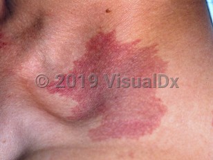 Clinical image of Port-wine stain - imageId=3351600. Click to open in gallery.  caption: 'A violaceous patch at the supraclavicular fossa.'