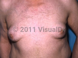 Clinical image of Gynecomastia - imageId=336348. Click to open in gallery.  caption: 'Enlarged breasts, secondary to a medication.'