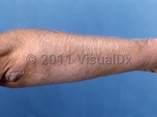 Clinical image of Acquired hypertrichosis lanuginosa - imageId=336883. Click to open in gallery.  caption: 'Marked hypertrichosis lanuginosa on the arm, secondary to a medication.'