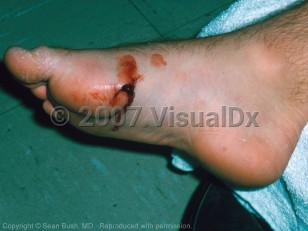 Clinical image of Stingray spine puncture - imageId=3379682. Click to open in gallery.  caption: 'A hemorrhagic and bleeding puncture wound on the foot (stingray spine puncture).'