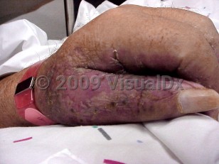 Clinical image of Nephrogenic systemic fibrosis - imageId=3417564. Click to open in gallery.  caption: 'A swollen hand with unrelated crusting and erythema.'