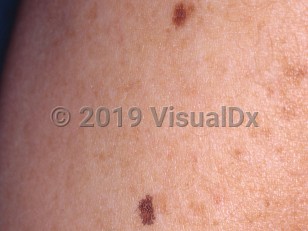 Clinical image of Lentigo simplex - imageId=3435273. Click to open in gallery.  caption: 'A close-up of two well-demarcated brown macules.'