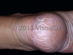 Clinical image of Heel fissure - imageId=3446788. Click to open in gallery.  caption: 'Linear cracks and surrounding hyperkeratosis of the heel.'