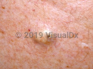 Clinical image of Epidermoid cyst - imageId=3463753. Click to open in gallery.  caption: 'A close-up of a yellowish nodule with a central keratin-filled punctum.'