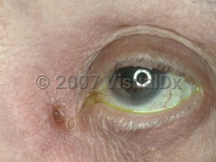 Clinical image of Lacrimal sac fistula - imageId=3520215. Click to open in gallery.  caption: 'A tiny deep defect at the medial canthus.'