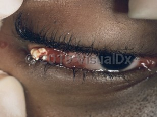 Clinical image of Lacrimal gland stones - imageId=3520439. Click to open in gallery.  caption: 'White material at the lateral eye with associated periorbital edema and conjunctival injection.'