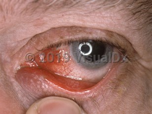 Clinical image of Canaliculitis - imageId=3520516. Click to open in gallery.  caption: 'Medial conjunctival injection, lower eyelid erythema, and a red, pouting punctum. '