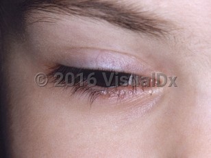 Clinical image of Third nerve palsy - imageId=3524543. Click to open in gallery.  caption: 'Eyelid ptosis.'