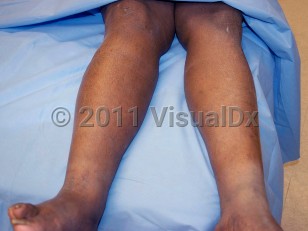 Clinical image of Deep vein thrombosis - imageId=3525996. Click to open in gallery.  caption: 'Increased girth of the right leg.'
