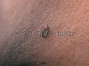 Clinical image of Acrochordon - imageId=3553735. Click to open in gallery.  caption: 'A close-up of a dark brown pedunculated papule.'
