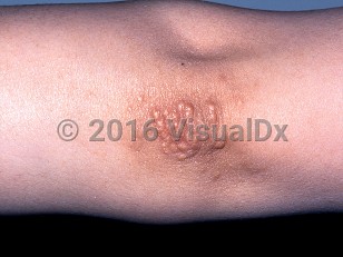 Clinical image of Tuberous xanthoma - imageId=356217. Click to open in gallery.  caption: 'Tuberoeruptive xanthomas showing yellowish and pinkish papules in a cluster on the elbow of a patient with familial type III hyperlipidemia.'