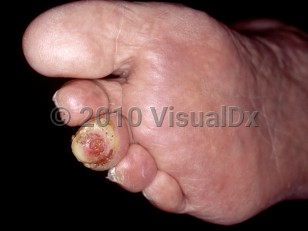 Clinical image of Diabetic neuropathy - imageId=3637027. Click to open in gallery.  caption: 'A small ulcer with surrounding thick, hyperkeratotic scale on the third toe.'