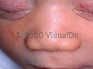 Clinical image of Sebaceous hyperplasia in newborn - imageId=3687622. Click to open in gallery.  caption: 'Multiple tiny, yellowish papules on the nose.'